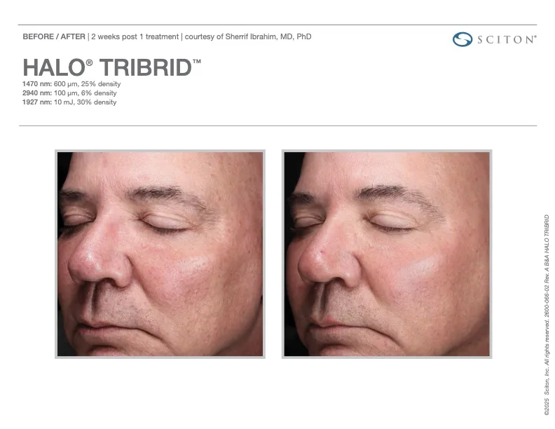 TRIBRID before and after - 2 weeks post 1 treatment