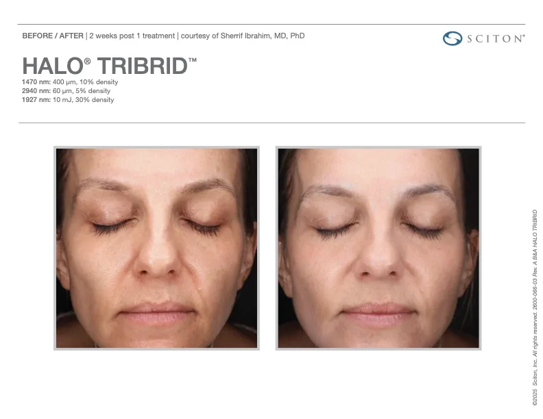 TRIBRID before and after - 2 weeks post treatment